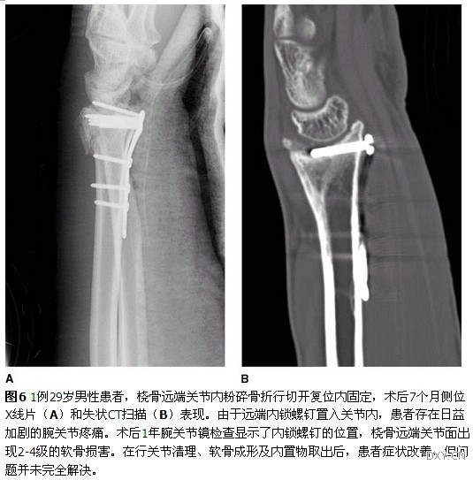 骨颈骨折最新研究，治疗、康复与预防的综合探讨