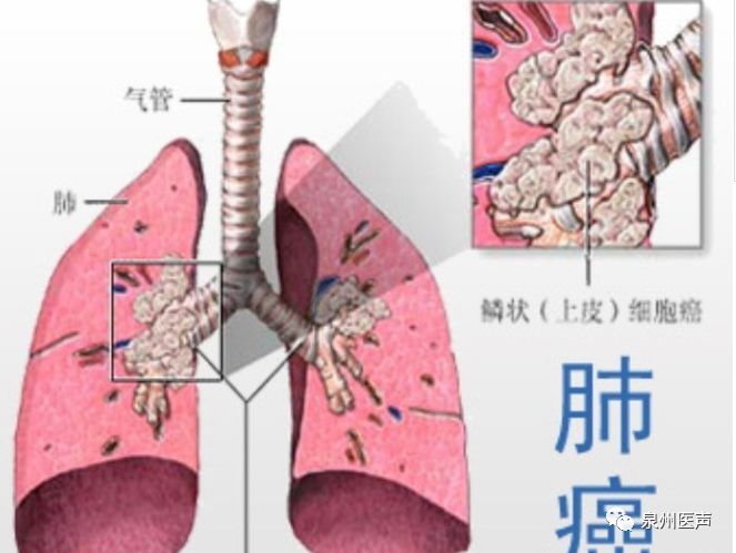 小细胞肺癌最新分期研究及最新治疗进展概述